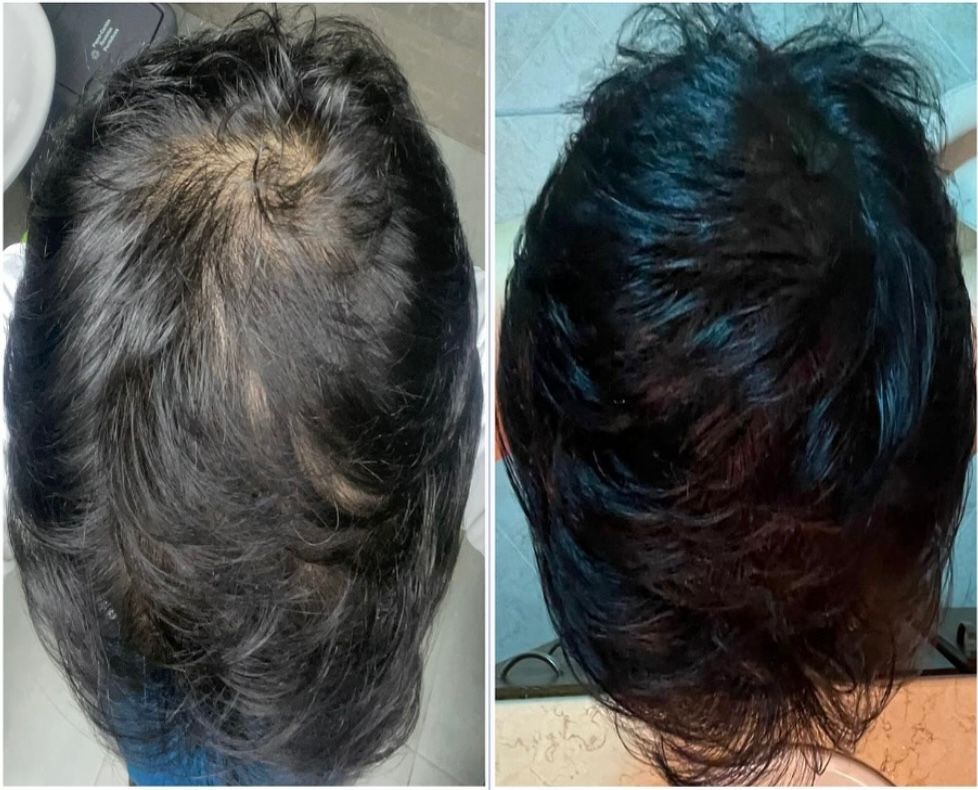 Tratamiento capilar Fórmula  con 18 activos naturales contra la caída del cabello y la alopecia ENVIO GRATIS